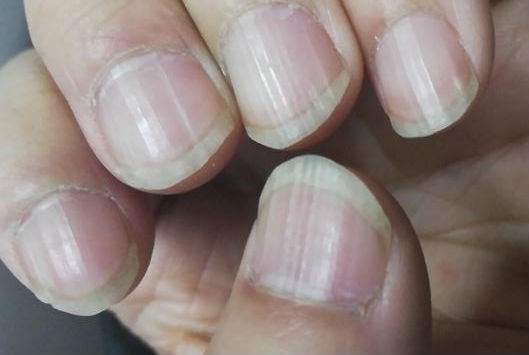 指甲上的月牙是什么?細數指甲出現的各種癥狀