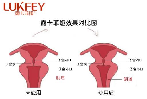 私護產品縮陰效果好嗎?揭開產品神秘面紗!