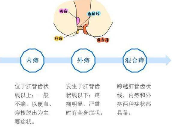 武漢漢西博仕肛腸醫院好不 痔瘡久拖不決的危害