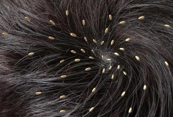 頭上有虱子怎么去除掉?虱子是怎么長出來的?虱子和跳蚤區別