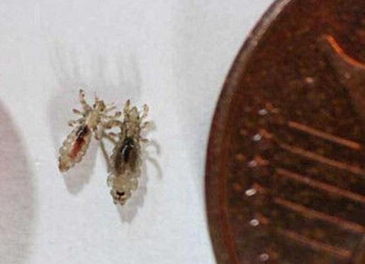 被虱子咬的癥狀圖片 關于虱子咬的癥狀的常見問題