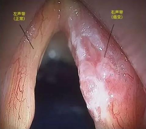 成都民生耳鼻喉醫院提醒:關于喉癌,我們所應該知道的