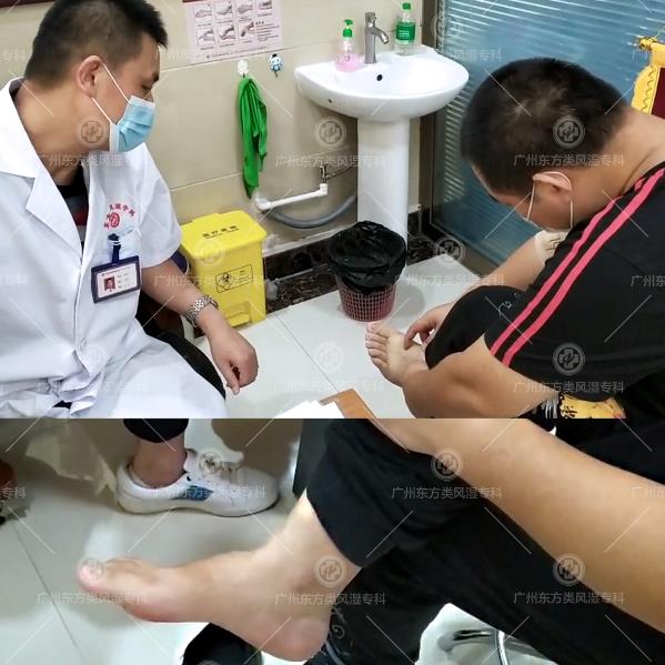 廣州東方類風(fēng)濕?圃趺礃 找對(duì)方法8年痛風(fēng)石也能消失