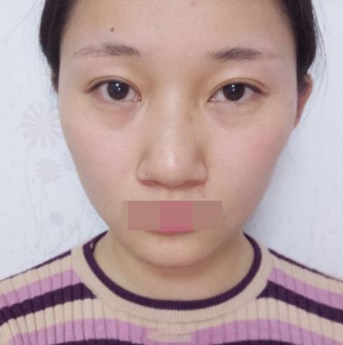 寧波玲瓏整形醫院解讀:除了忌口,做隆鼻也沒有我想的那么麻煩!