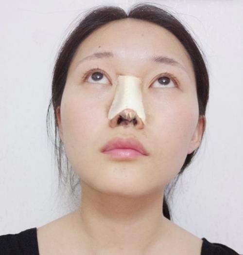 寧波玲瓏整形醫院解讀:除了忌口,做隆鼻也沒有我想的那么麻煩!