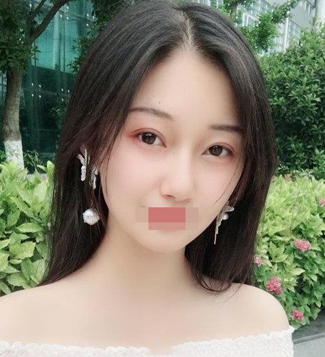 寧波玲瓏整形醫院解讀:除了忌口,做隆鼻也沒有我想的那么麻煩!