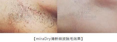秒殺腋臭手術的止汗凈味黑科技——miraDry清新微波!