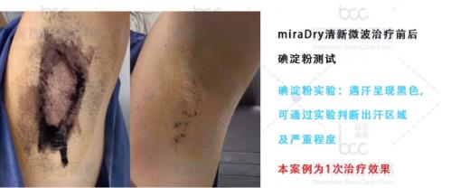 秒殺腋臭手術的止汗凈味黑科技——miraDry清新微波!