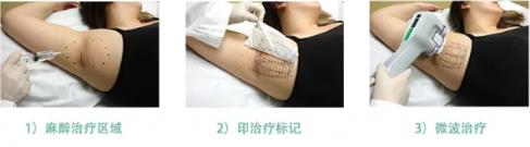 秒殺腋臭手術的止汗凈味黑科技——miraDry清新微波!
