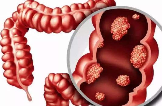 引發結腸息肉的因素有哪些?結腸息肉有哪些治療方式?