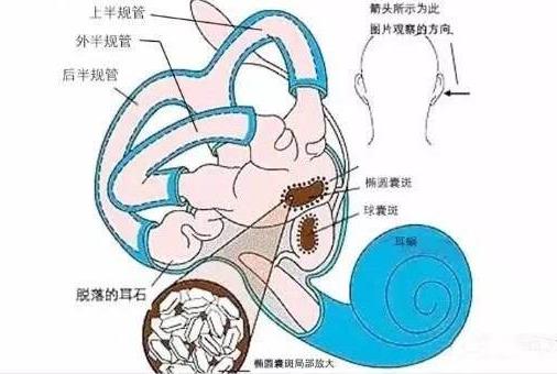 耳朵里有石頭還頭暈,成都民生耳鼻喉醫院提醒你:這是耳石癥!