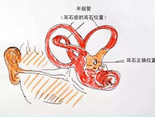 耳朵里有石頭還頭暈,成都民生耳鼻喉醫院提醒你:這是耳石癥!