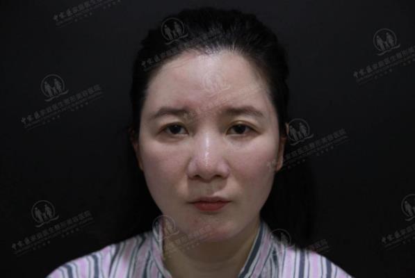 中家醫整形23周年慶帶你了解做線雕6大優勢和效果!