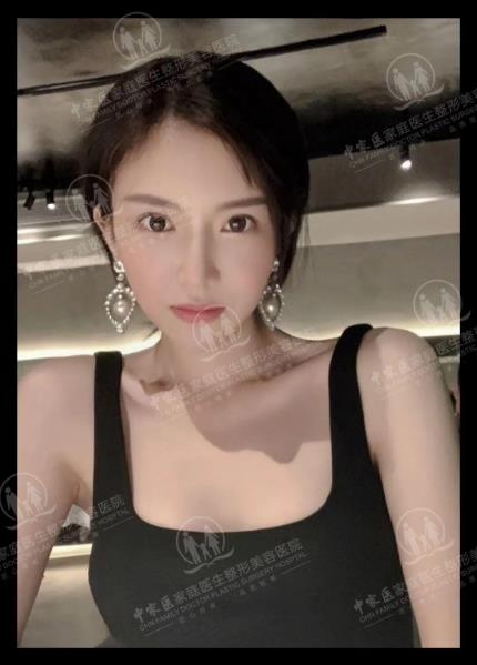中家醫整形23周年慶帶你了解做線雕6大優勢和效果!