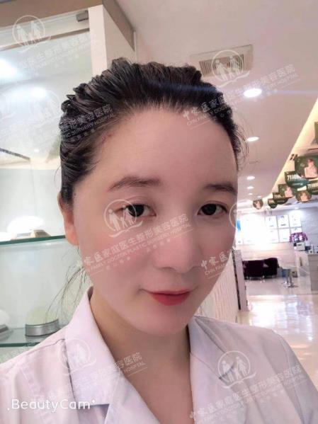 中家醫整形23周年慶帶你了解做線雕6大優勢和效果!