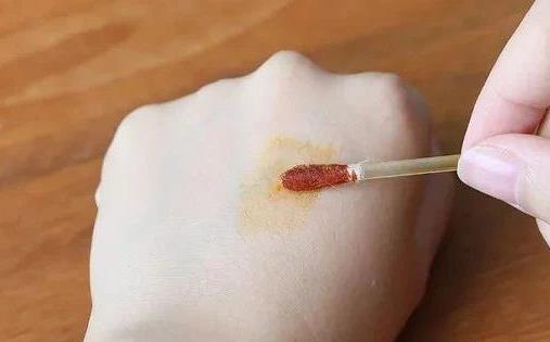 什么是疤痕體質?疤痕體質的人需要注意什么?