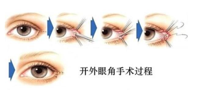 寧波薇琳醫院靠譜嗎:做乳頭縮小術去哪好