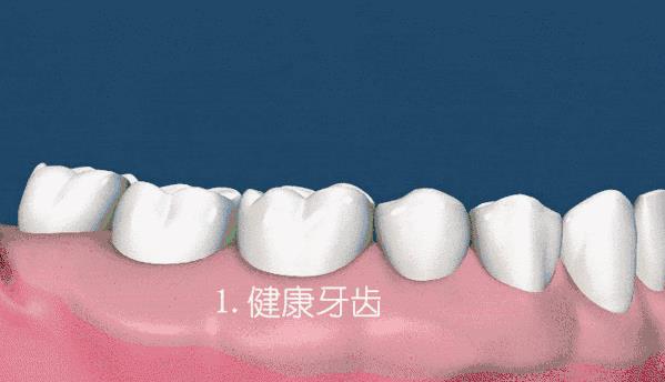 全民愛牙公益行動牙齦炎癥的危害