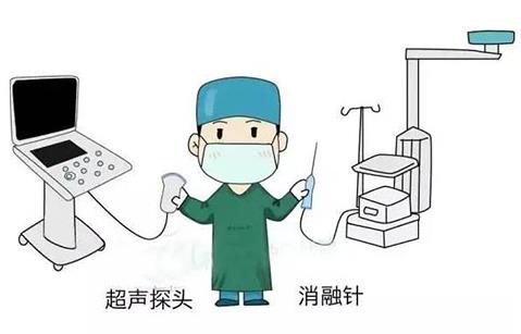 濟南顯微外科醫院為20歲甲狀腺結節患者消融治療,美觀無疤痕
