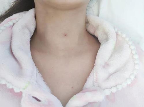 濟南顯微外科醫院為20歲甲狀腺結節患者消融治療,美觀無疤痕