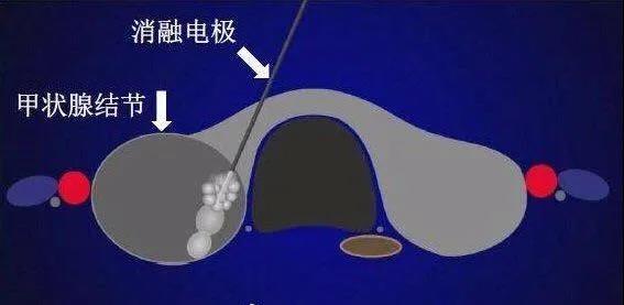 濟南顯微外科醫院為20歲甲狀腺結節患者消融治療,美觀無疤痕