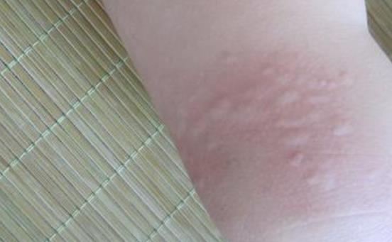 什么是皮膚過敏?哪些水果容易引起過敏?