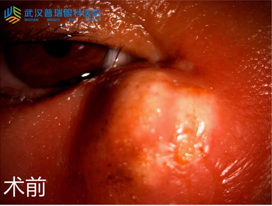 眼角疼還脹起膿包 慢性淚囊炎發作嚇壞六旬阿姨