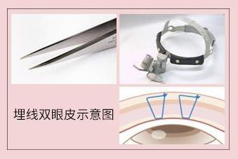 圣心醫療美容雙眼皮術:疫情期間,人人都是“眼”技派