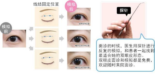 圣心醫療美容雙眼皮術:疫情期間,人人都是“眼”技派