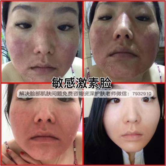 激素滿月臉還有救嗎?屢試不爽的激素臉救星竟是它!