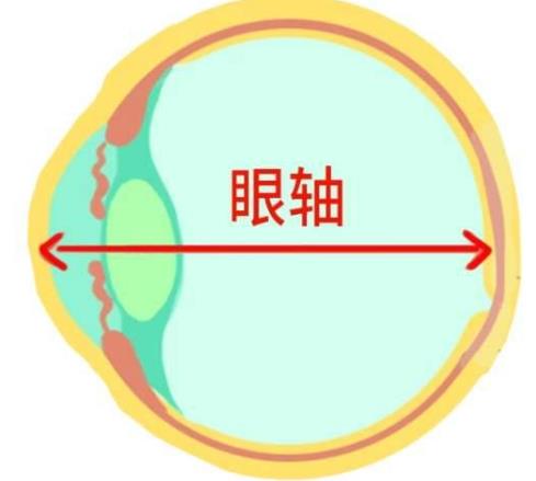 北京茗視光眼科:眼軸增長1mm孩子近視就增加300度嗎?