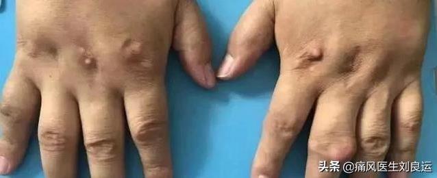 成都西部痛風風濕醫院靠譜嗎?技術精湛 正規靠譜