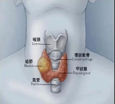 53歲阿姨查出甲狀腺癌,成都民生耳鼻喉為她成功實施手術