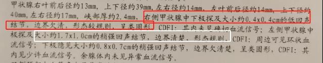 53歲阿姨查出甲狀腺癌,成都民生耳鼻喉為她成功實施手術