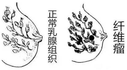 乳腺纖維瘤你怕了嗎?我的治療經歷分享給姐妹們