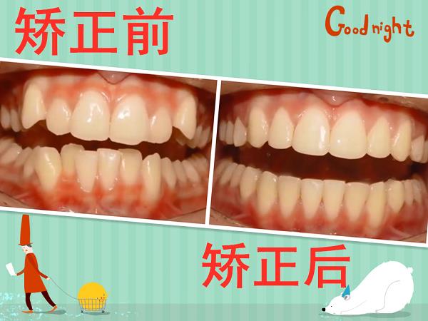 牙齒矯正前要做哪些準備?昆明德韓口腔為您解答!