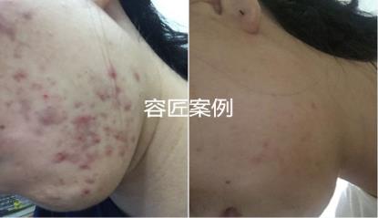 容匠祛痘分享課堂:為什么你會長丘疹性痤瘡?