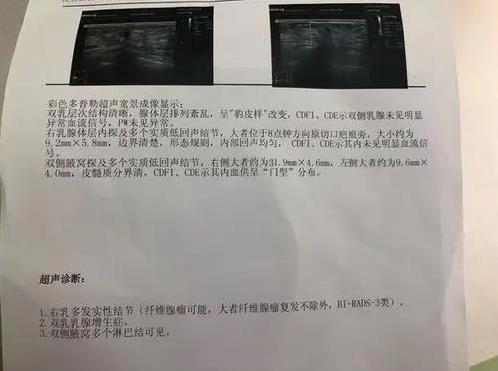 【一位女性自述】我和乳腺疾病抗?fàn)幍娜兆?如何重獲健康人生