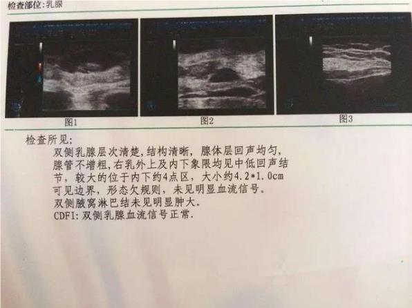【一位女性自述】我和乳腺疾病抗?fàn)幍娜兆?如何重獲健康人生