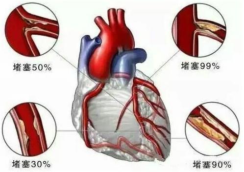 杭州怡養醫院發聲:年輕人,你離心腦血管疾病沒多遠!