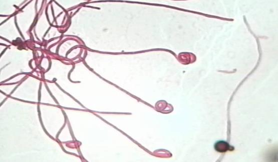 什么是放線菌病?放線菌病的癥狀有哪些?
