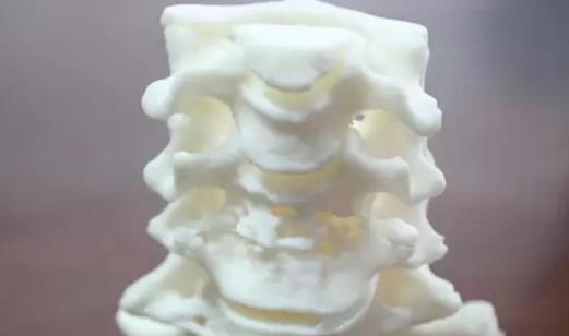 頸椎結核會有哪些后遺癥?頸椎結核有哪些癥狀?