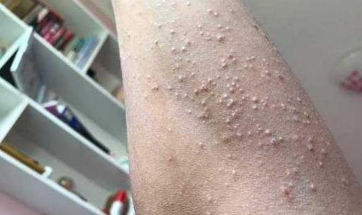 患疥瘡的原因有哪些?疥瘡有哪些并發(fā)癥?