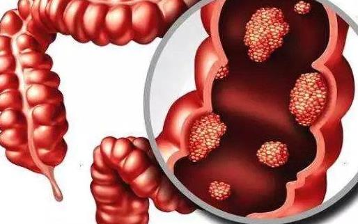 結腸炎和潰瘍性結腸炎有哪些區別?為什么會患潰瘍性結腸炎?