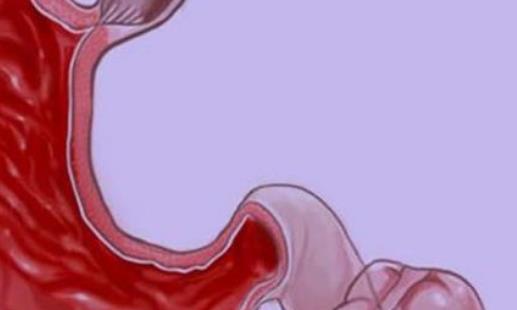 潰瘍性結腸炎有哪些并發癥?潰瘍性結腸炎需要做哪些檢查?