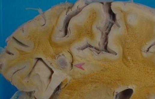 盤點顱內鈣化的各種原因