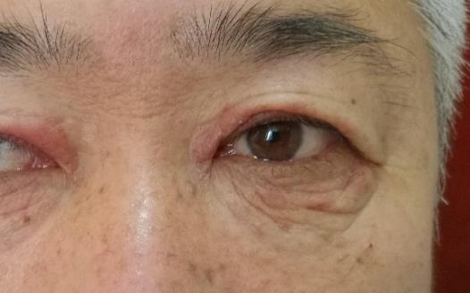 哪些人易患淚液分泌過多?淚液分泌過多有哪些并發癥?