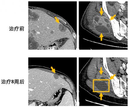 兩個月咳出腫瘤組織,高響應率非小細胞肺癌靶向藥將改變患者命運