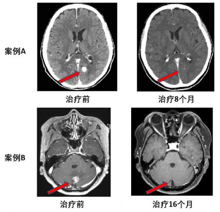 兩個月咳出腫瘤組織,高響應率非小細胞肺癌靶向藥將改變患者命運