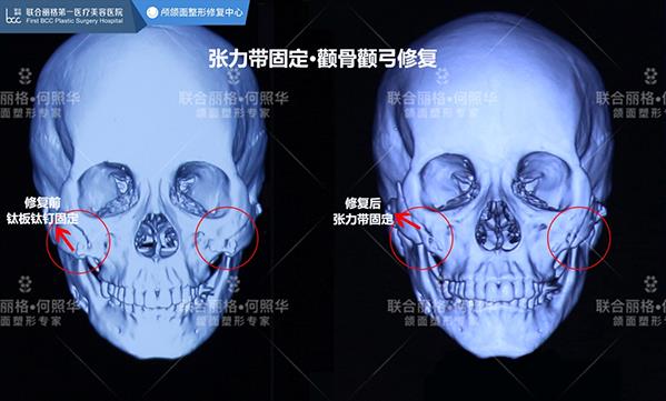 顴骨內推,為什么首選張力帶固定技術?【聯合麗格何照華教授】